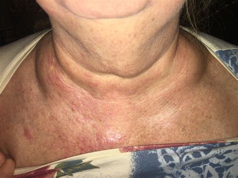 There is also evidence that a specific symptom of anxiety creates the illusion of swelling. . Rash and swollen lymph nodes armpit